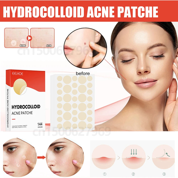 Pimple Patch Face - 144pcs Acne Patches